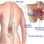 Thoái vị đĩa đệm là gì? Chi phí chữa trị ra sao?