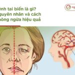 Bệnh tai biến là gì? Nguyên nhân và cách phòng ngừa hiệu quả