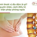 Bệnh thoát vị đĩa đệm là gì? Nguyên nhân, cách điều trị và biện pháp phòng ngừa